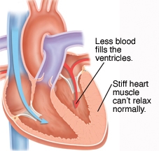 Heart Failure | Nevada Heart & Vascular Center