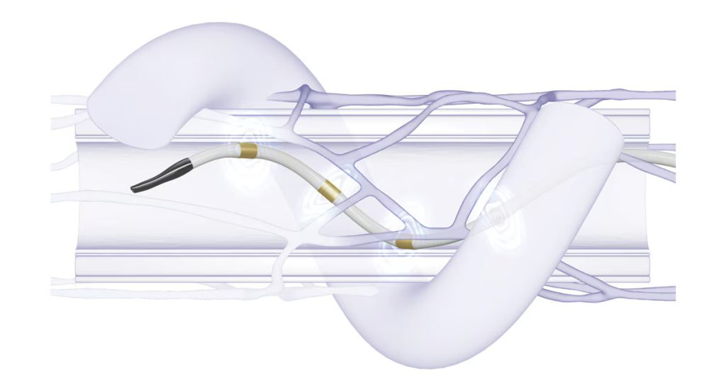 renal denervation ablation